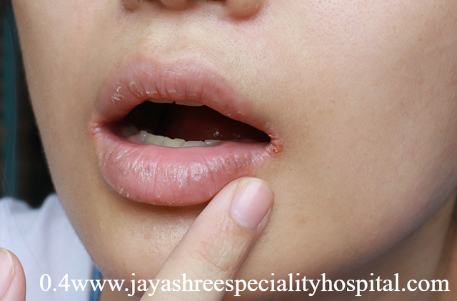 Kenali Penyebab dan Cara Mengatasi Mulut Kering