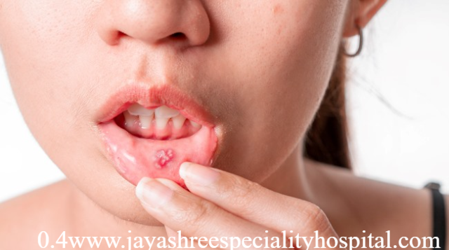 Kenali Perbedaan Sariawan Biasa dan Herpes