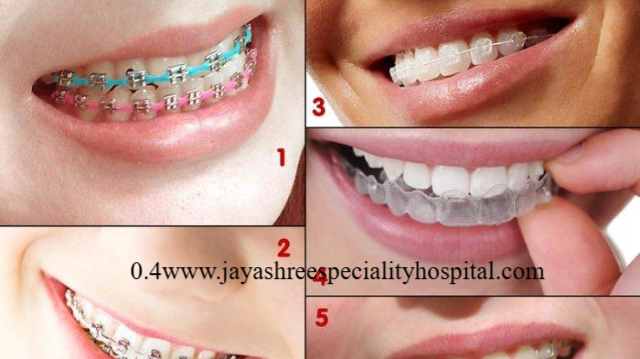 Jenis Kawat Gigi dengan Kelebihan dan Kekurangannya