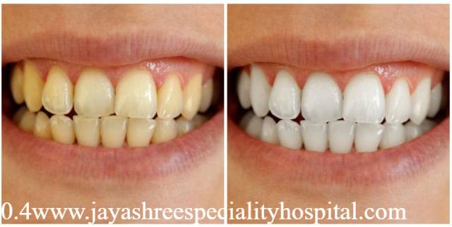 Berapa Lama Hasil Bleaching Gigi Bertahan